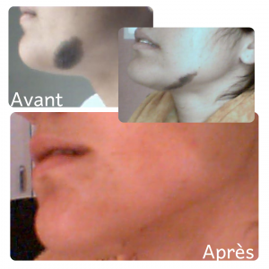 Dr Berrada Khalid - Chirurgien esthétique et plastique à Fès TUMEURS CUTANES dr berrada khalid photo avant apresOK 1 Chirurgie réparatrice