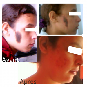 Dr Berrada Khalid - Chirurgien esthétique et plastique à Fès TUMEURS CUTANES dr berrada khalid photo avant apresok 2 Chirurgie réparatrice