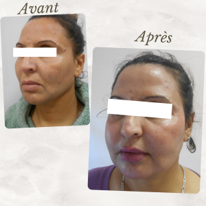 Chirurgie du visage 7 Dr Berrada Khalid - Chirurgien esthétique et plastique à Fès lipofilling de visage dr berrada khalid photo avant apresLipof de visage dr berrada khalid photo avant apres11 Chirurgie du visage