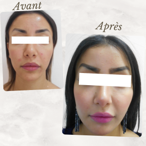 Chirurgie du visage 15 Dr Berrada Khalid - Chirurgien esthétique et plastique à Fès lipofilling de visage dr berrada khalid photo avant apresLipof de visage dr berrada khalid photo avant apres16 Chirurgie du visage
