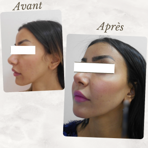 Chirurgie du visage 14 Dr Berrada Khalid - Chirurgien esthétique et plastique à Fès lipofilling de visage dr berrada khalid photo avant apresLipof de visage dr berrada khalid photo avant apres17 Chirurgie du visage