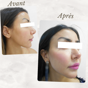 Chirurgie du visage 13 Dr Berrada Khalid - Chirurgien esthétique et plastique à Fès lipofilling de visage dr berrada khalid photo avant apresLipof de visage dr berrada khalid photo avant apres18 Chirurgie du visage