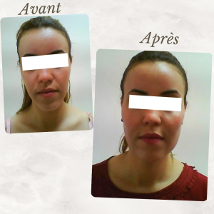Chirurgie du visage 12 Dr Berrada Khalid - Chirurgien esthétique et plastique à Fès lipofilling de visage dr berrada khalid photo avant apresLipof de visage dr berrada khalid photo avant apres24 Chirurgie du visage