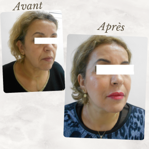Chirurgie du visage 9 Dr Berrada Khalid - Chirurgien esthétique et plastique à Fès lipofilling de visage dr berrada khalid photo avant apresLipof de visage dr berrada khalid photo avant apres5 Chirurgie du visage