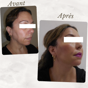 Chirurgie du visage 8 Dr Berrada Khalid - Chirurgien esthétique et plastique à Fès lipofilling de visage dr berrada khalid photo avant apresLipof de visage dr berrada khalid photo avant apres8 Chirurgie du visage