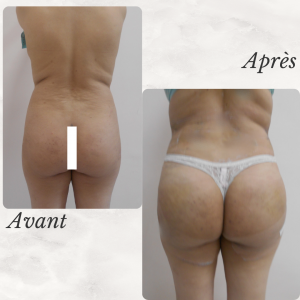 Dr Berrada Khalid - Chirurgien esthétique et plastique à Fès lipofilling des fesses dr berrada khalid photo avant apres10 Interventions
