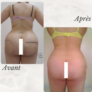 Dr Berrada Khalid - Chirurgien esthétique et plastique à Fès lipofilling des fesses dr berrada khalid photo avant apres11 chirurgie de la Silhouette