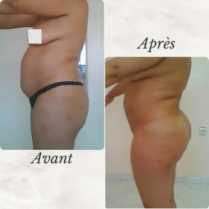 Dr Berrada Khalid - Chirurgien esthétique et plastique à Fès lipofilling des fesses dr berrada khalid photo avant apres2 chirurgie de la Silhouette