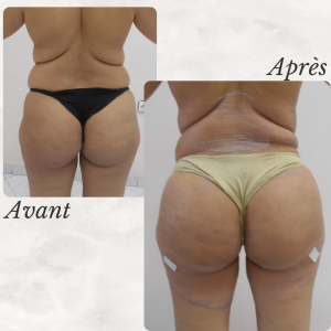 Dr Berrada Khalid - Chirurgien esthétique et plastique à Fès lipofilling des fesses dr berrada khalid photo avant apres6 Interventions