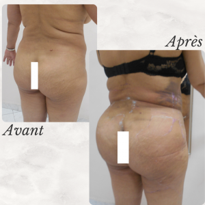 Dr Berrada Khalid - Chirurgien esthétique et plastique à Fès lipofilling des fesses dr berrada khalid photo avant apres8 chirurgie de la Silhouette