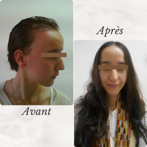 Dr Berrada Khalid - Chirurgien esthétique et plastique à Fès prp dr berrada avant apres Interventions